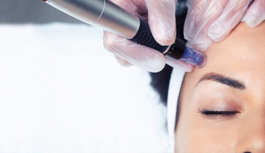 Dermapen kezelés az Apollon Beauty kozmetikában